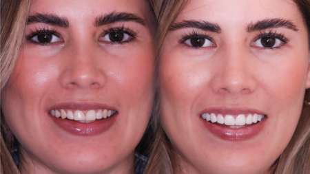 Carillas Dentales Antes y Despues