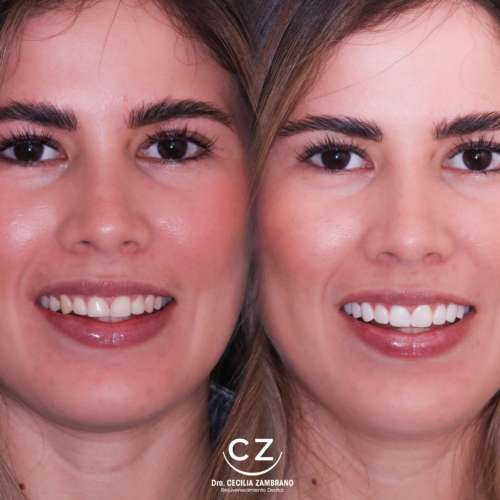 Carillas Dentales Antes y Despues