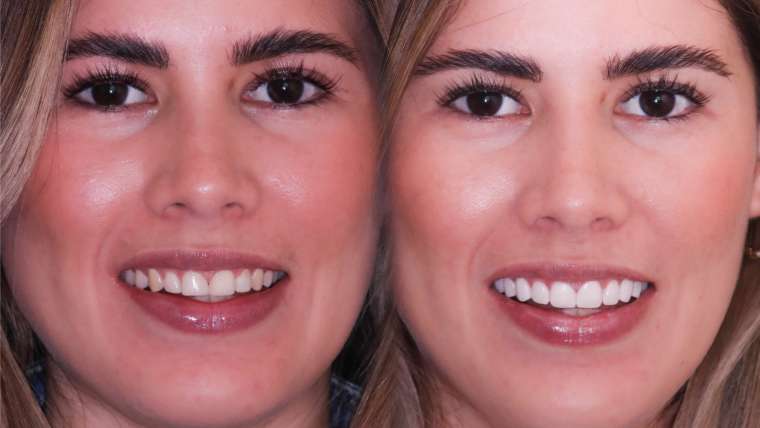 Carillas Dentales Antes y Despues