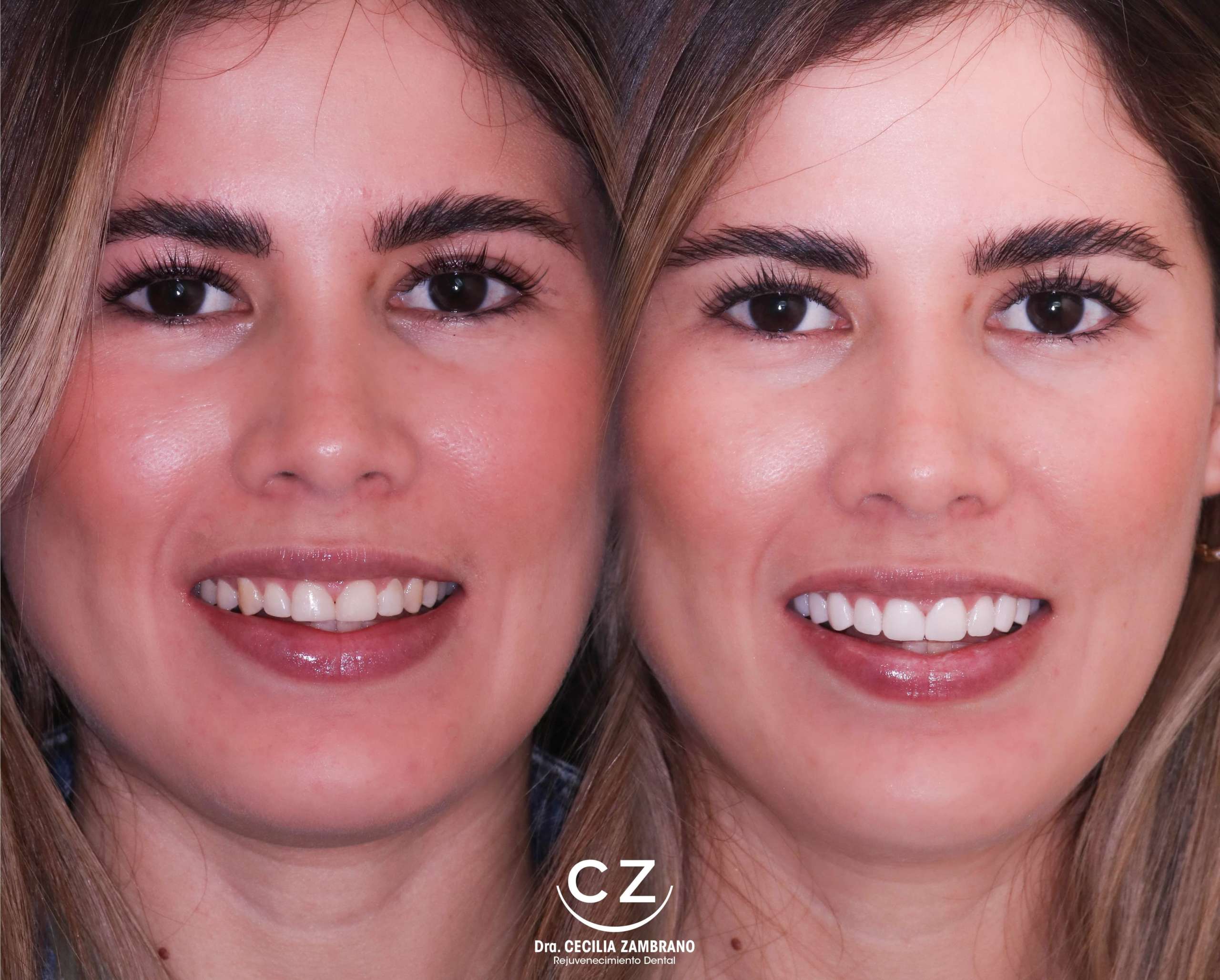 Carillas Dentales Antes y Despues