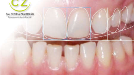 Diseno de Sonrisa con Dra. Cecilia Zambrano | Quito & Cumbaya
