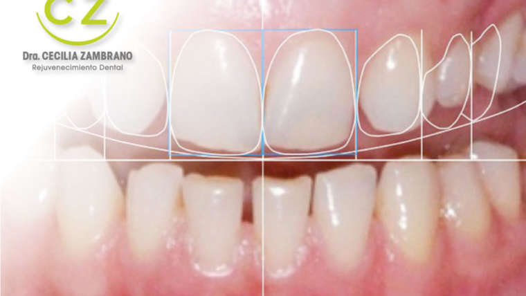 Diseno de Sonrisa con Dra. Cecilia Zambrano | Quito & Cumbaya