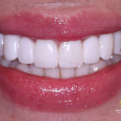 Diseño de sonrisa con carillas de resina | Quito | Dra. Cecilia Zambrano