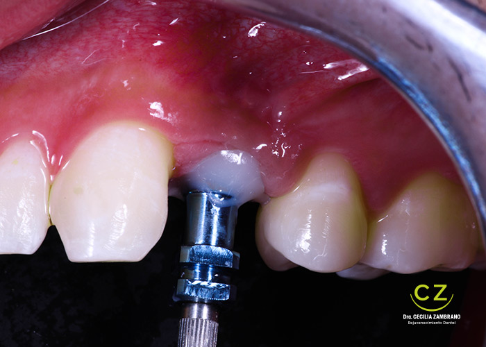 draceciliazambrano-implantes-dentales-4