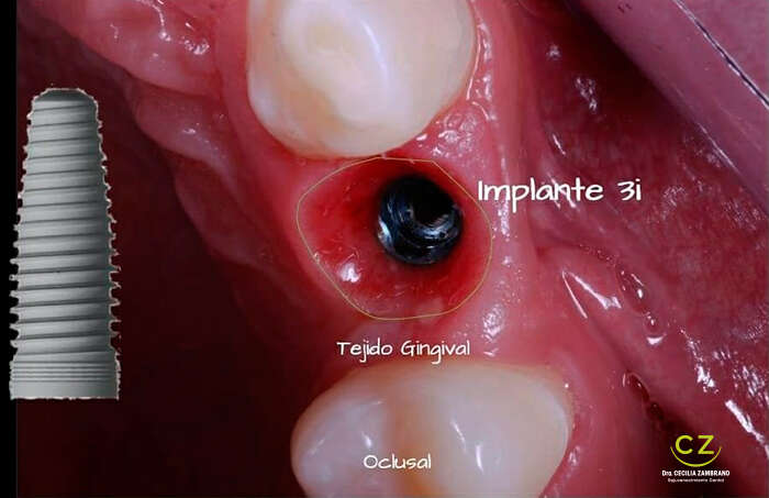 draceciliazambrano-implantes-portada