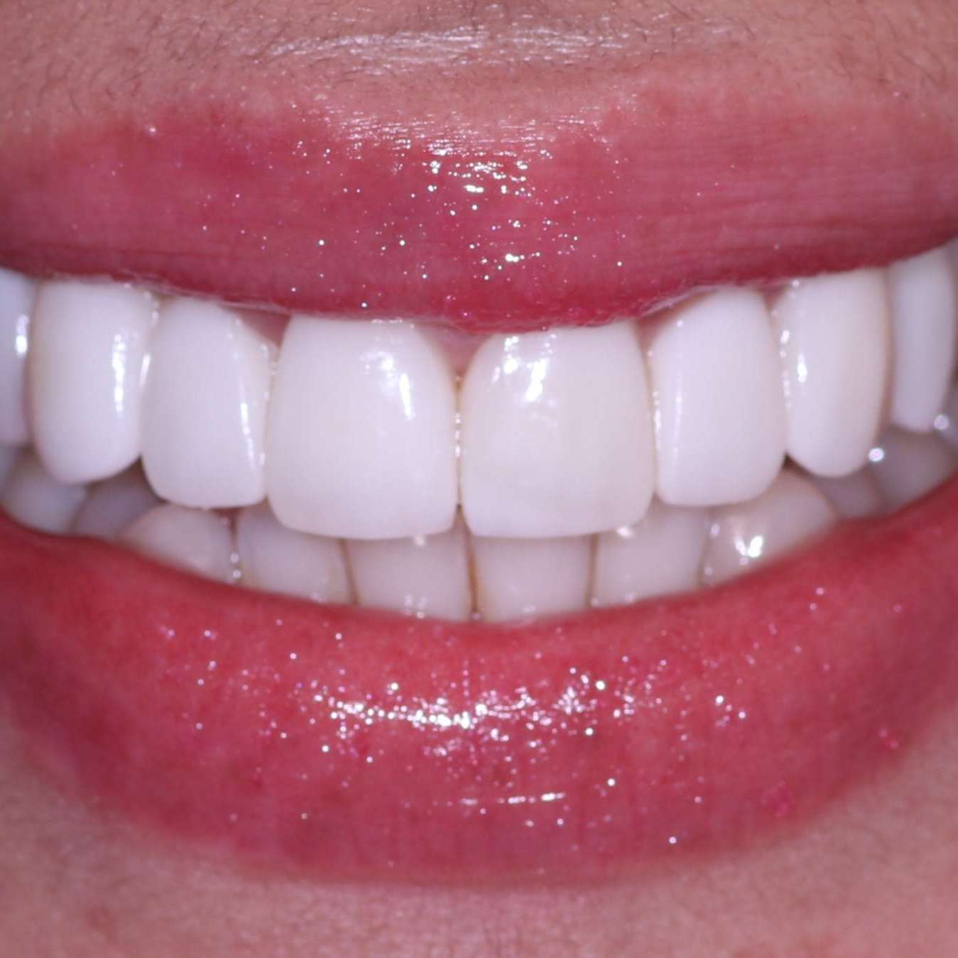 Tratamiento Carillas Dentales Quito Dra. Cecilia Zambrano