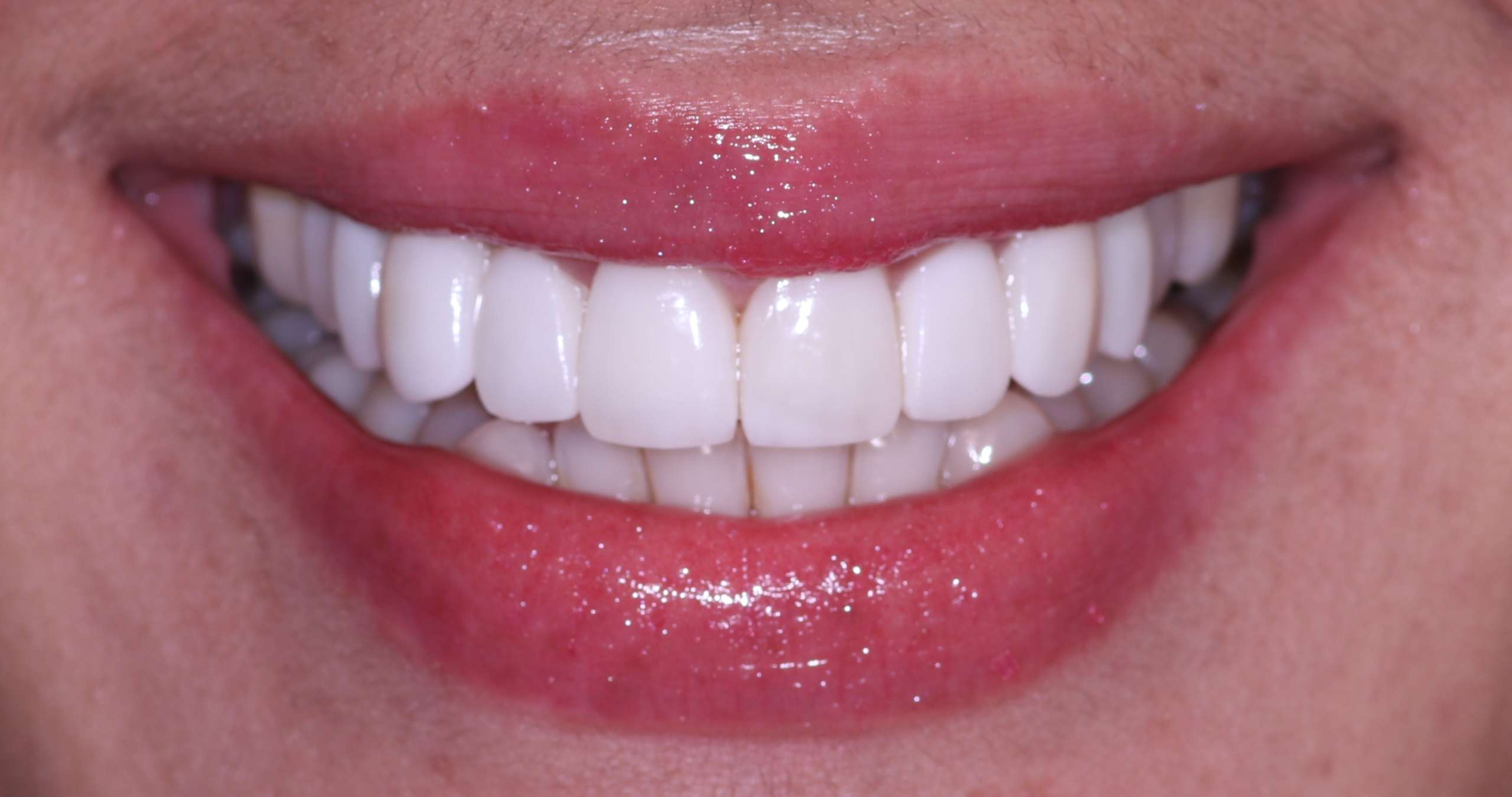 Tratamiento Carillas Dentales Quito Dra. Cecilia Zambrano