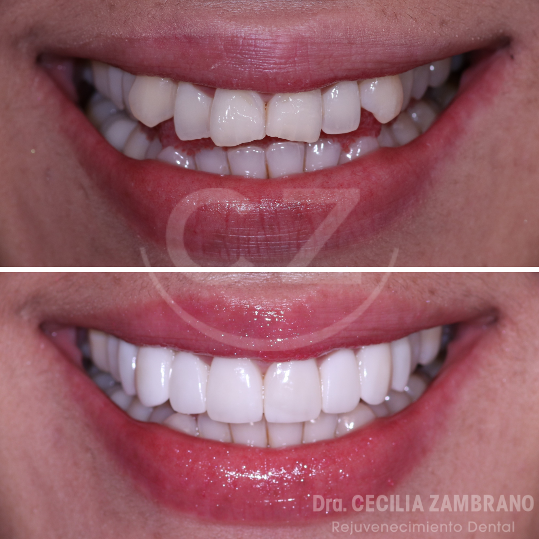 Carillas dentales quito antes y despues | dra. Cecilia Zambrano