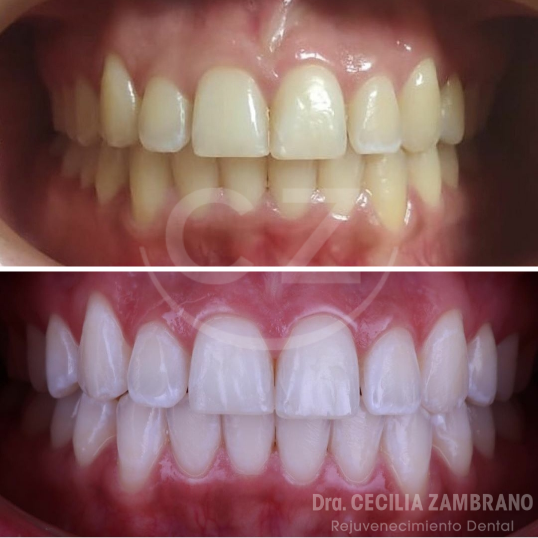 Carillas dentales resina quito Dra. Cecilia Zambrano