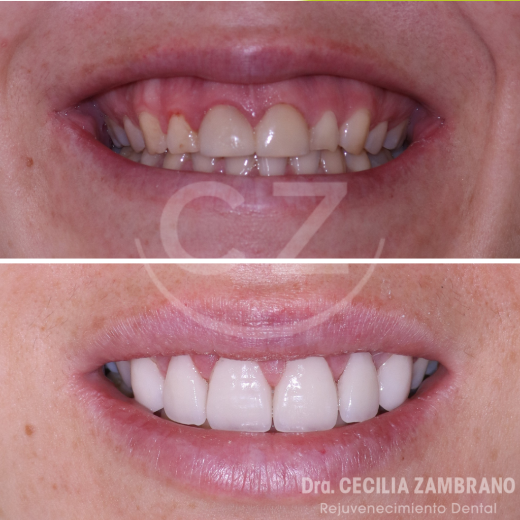 Carillas Dentales | Dra. Cecilia Zambrano | Quito