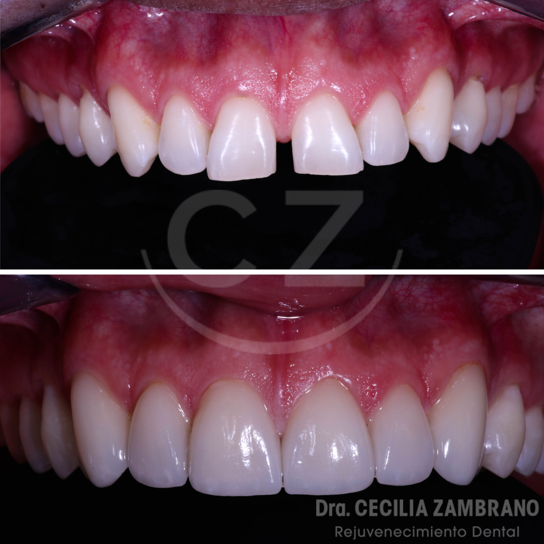 Antes y despues carillas dentales de porcelana Quito | Dra. Cecilia Zambrano