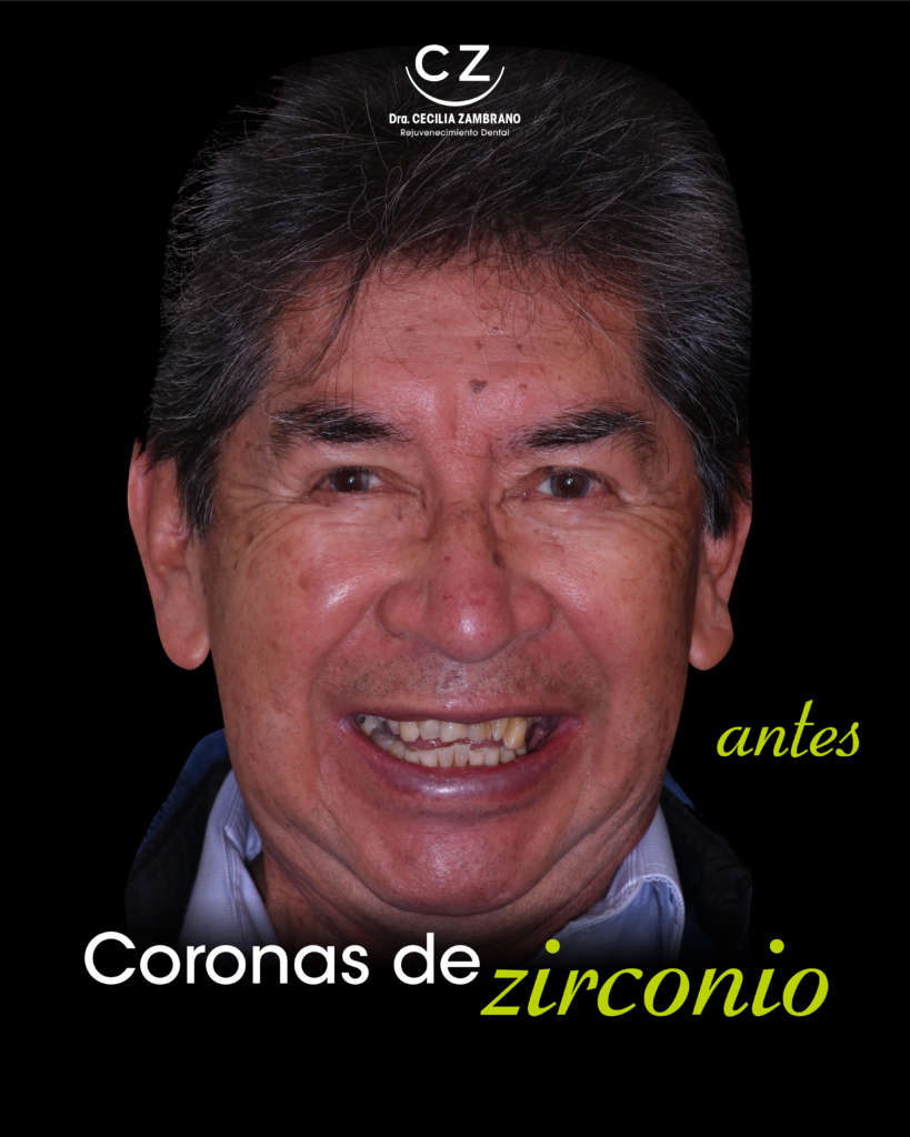 Carillas dentales en Zirconio