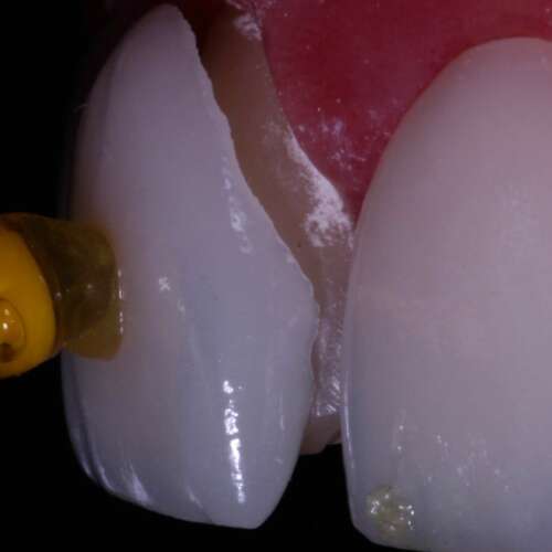 Carillas Dentales