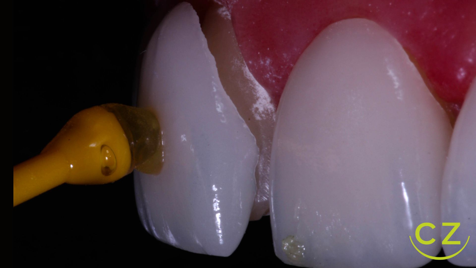 Carillas Dentales