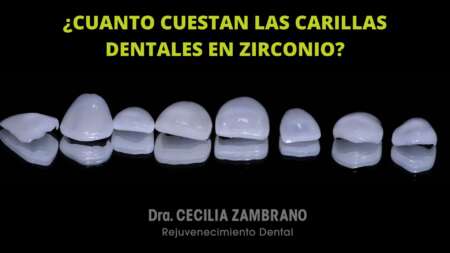 Carillas de Zirconio