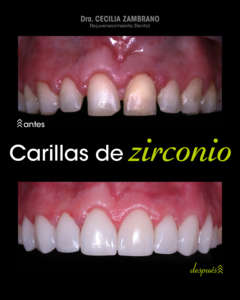 Coronas dentales Zirconio Dra. Cecilia Zambrano Quito