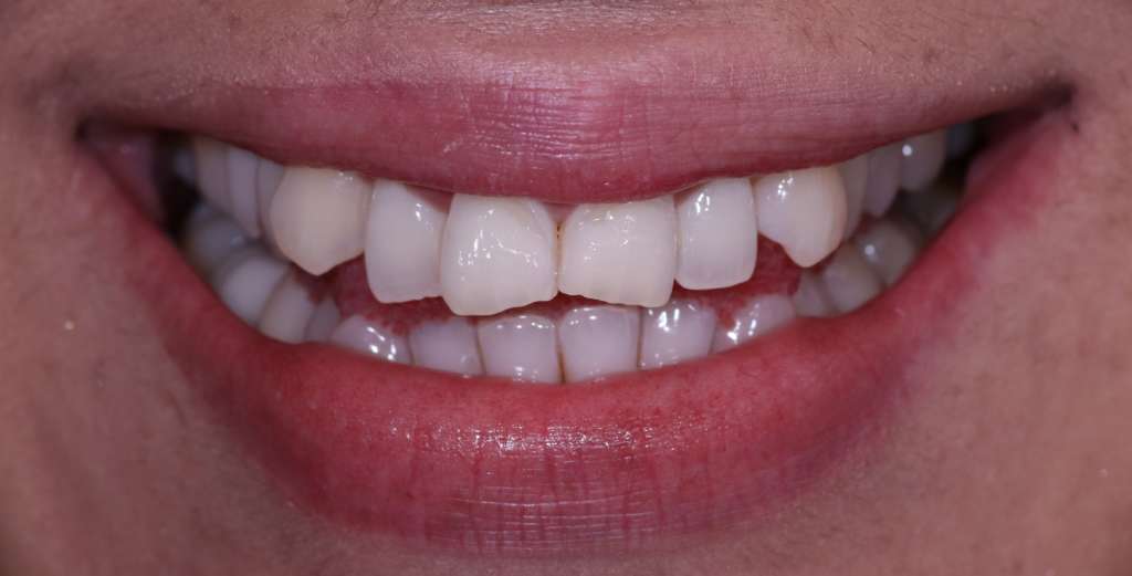 Dientes desalineados 