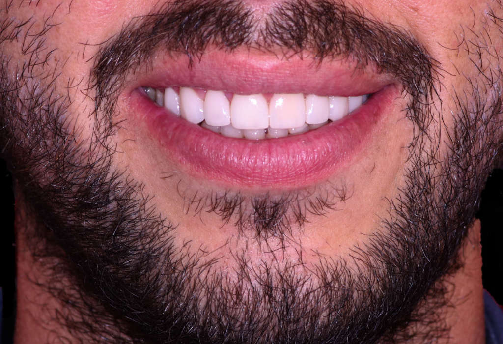 Carillas Dentales Quito Dra. Cecilia Zambrano