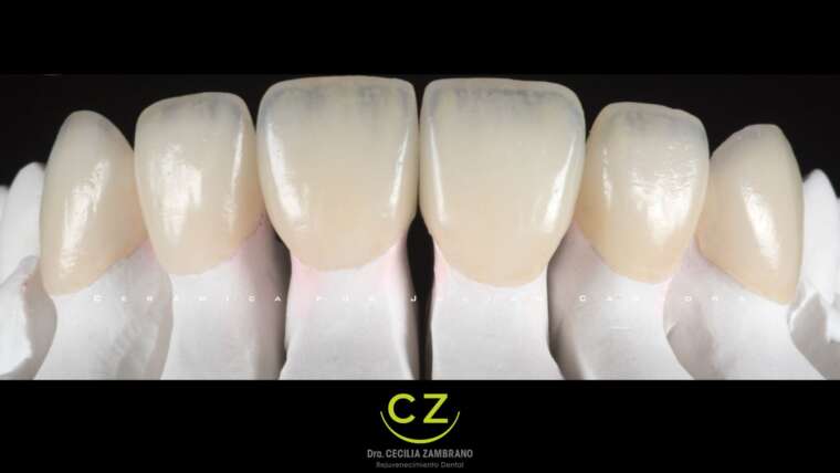 Carillas de Zirconioa