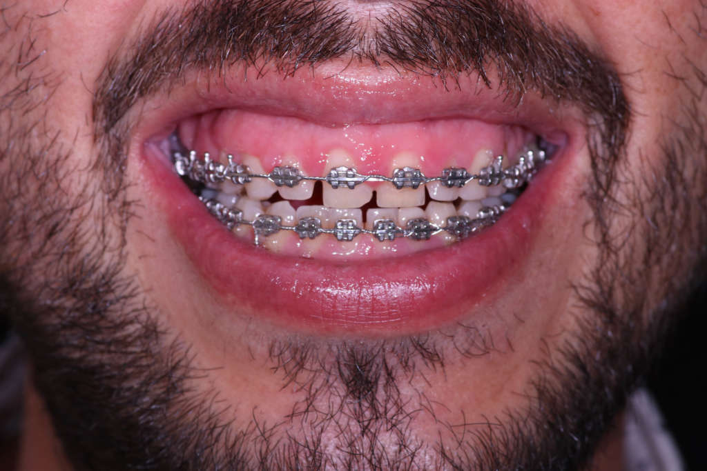 Braquets Quito Dra. Cecilia Zambrano