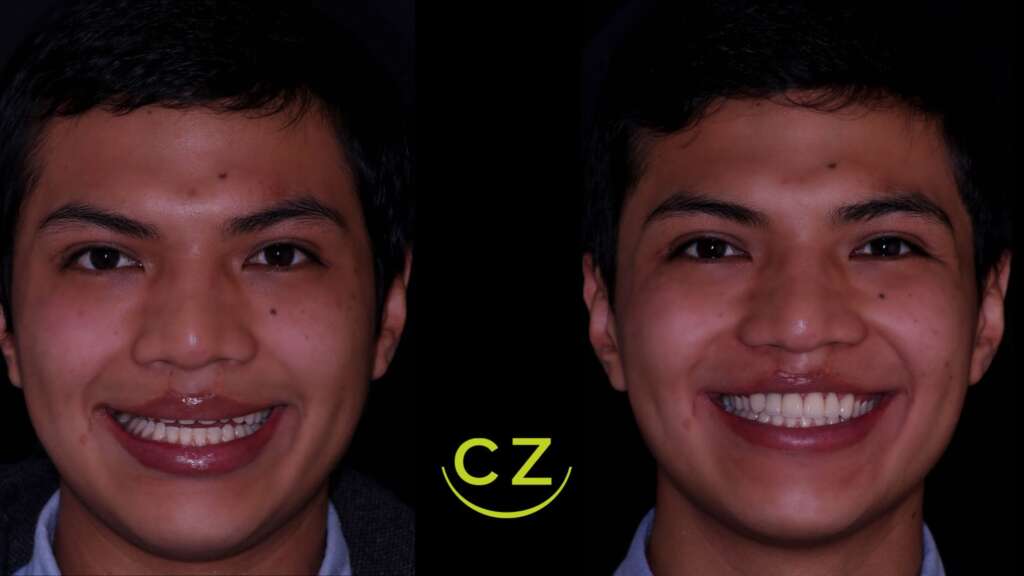 Antes y Despues | Diseño de Sonrisa ] Dra. Cecilia Zambrano