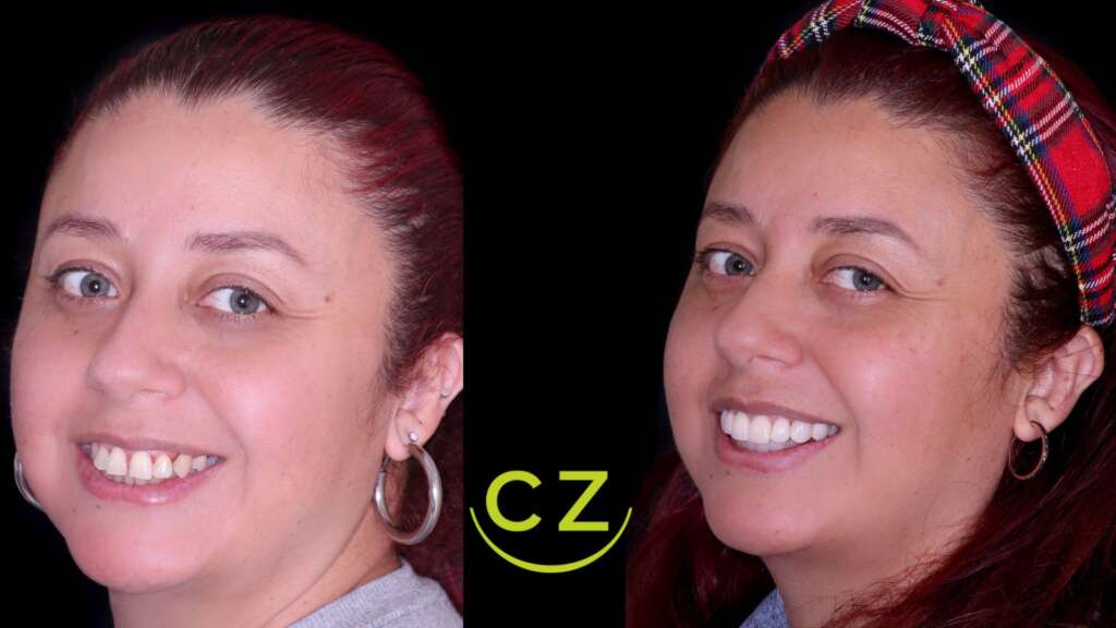Diseno de Sonrisa Antes y Despues