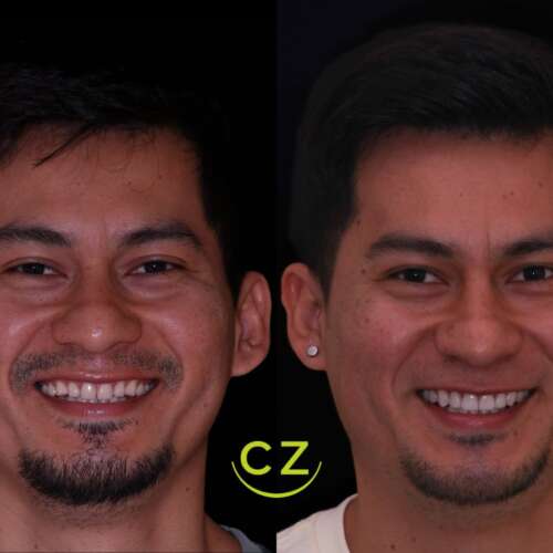 Antes y Despues Resultados Diseno de Sonrisa Quito | Dra. Cecilia Zambrano