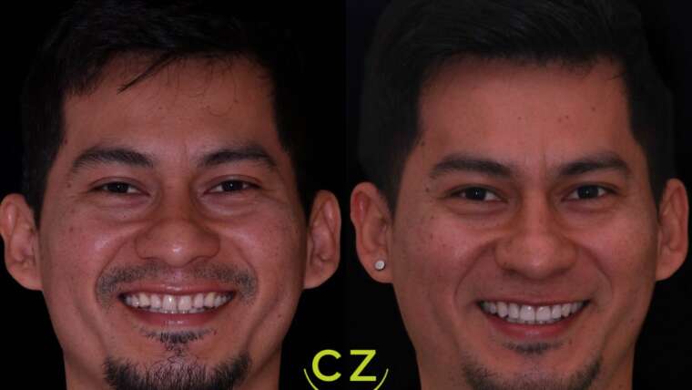 Antes y Despues Resultados Diseno de Sonrisa Quito | Dra. Cecilia Zambrano