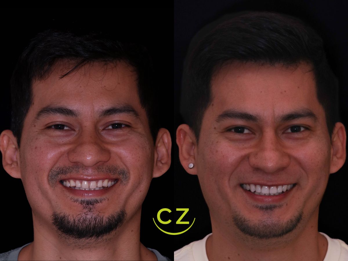 Antes y Despues Resultados Diseno de Sonrisa Quito | Dra. Cecilia Zambrano