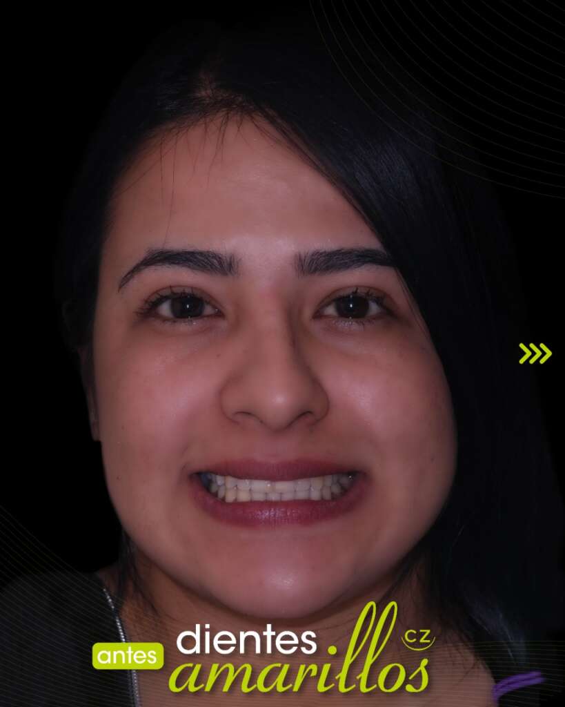 Blanqueamiento Dental en Quito, Ecuador