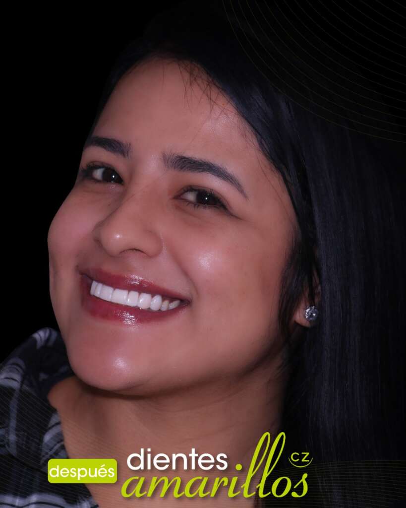 Blanqueamiento Dental Dra. Cecilia Zambrano Quito Ecuador