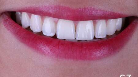 Blanqueamiento Dental en Quito | Dra. Ceciilia Zambrano