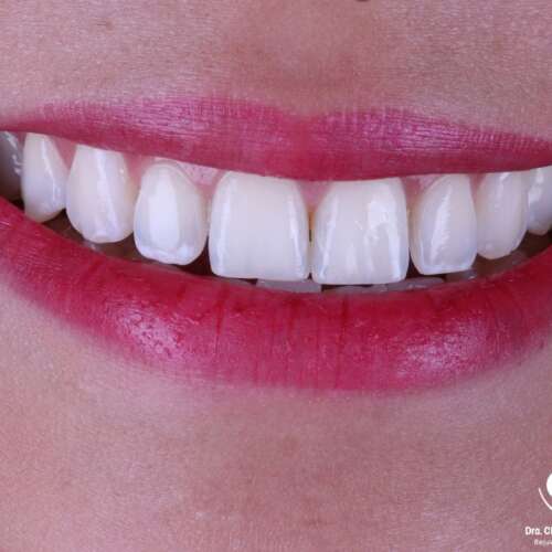 Blanqueamiento Dental en Quito | Dra. Ceciilia Zambrano