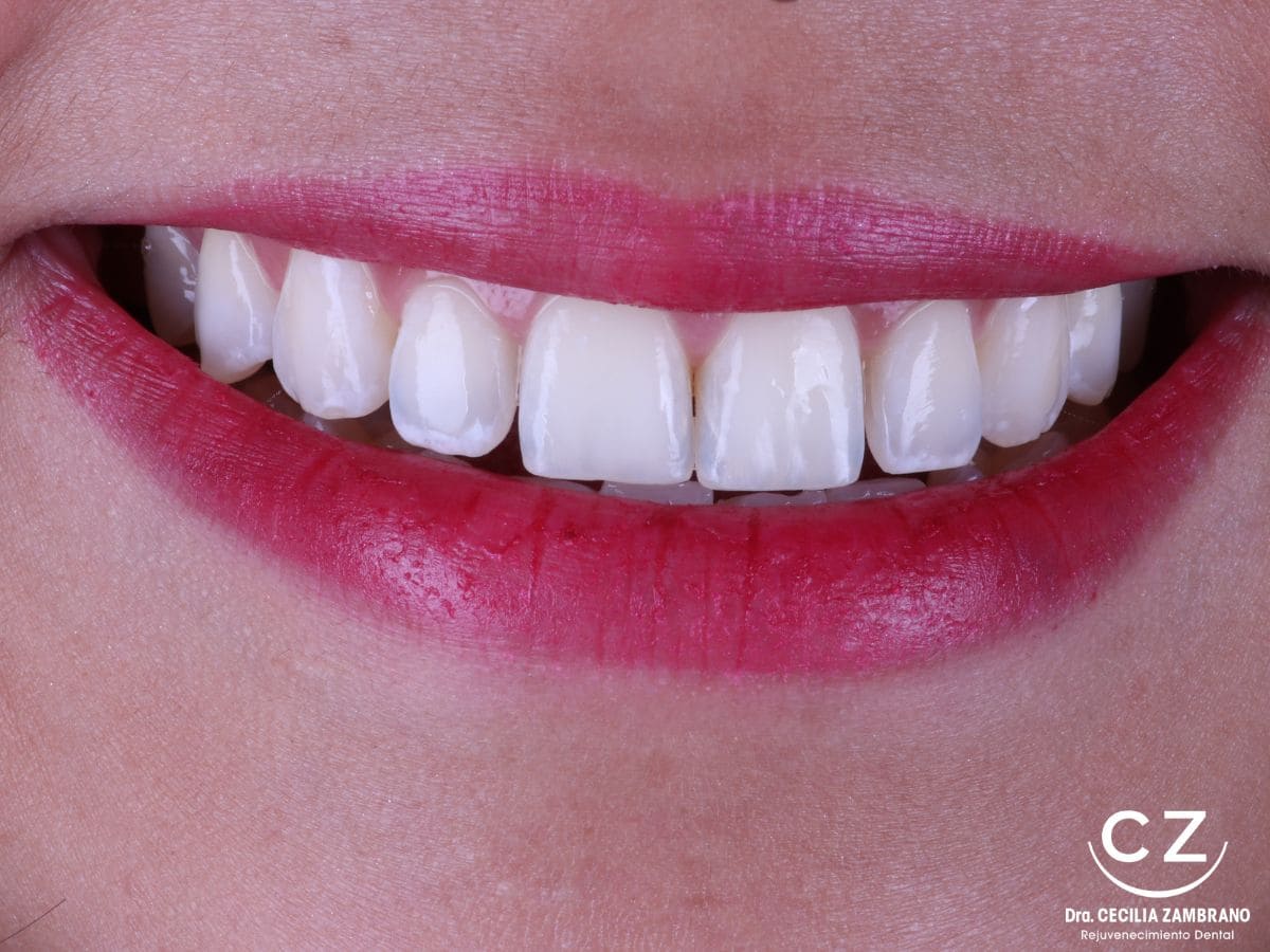 Blanqueamiento Dental en Quito | Dra. Ceciilia Zambrano