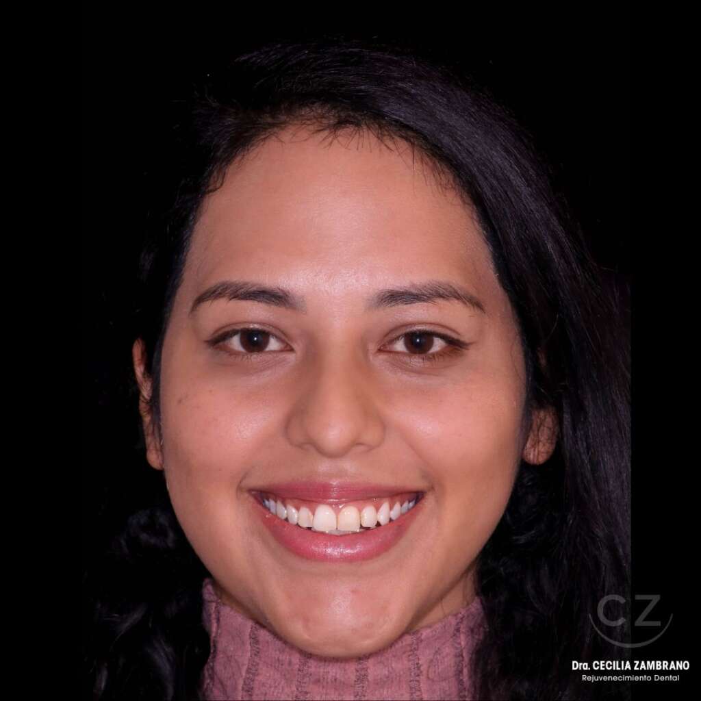 Diseno de sonrisa Antes del Tratamiento Dra. Cecilia Zambrano