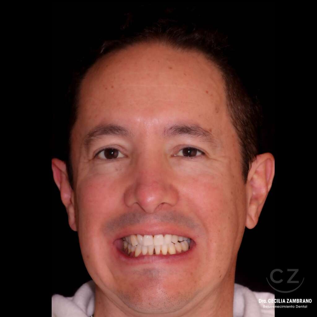 Diseno de sonrisa antes del procedimiento