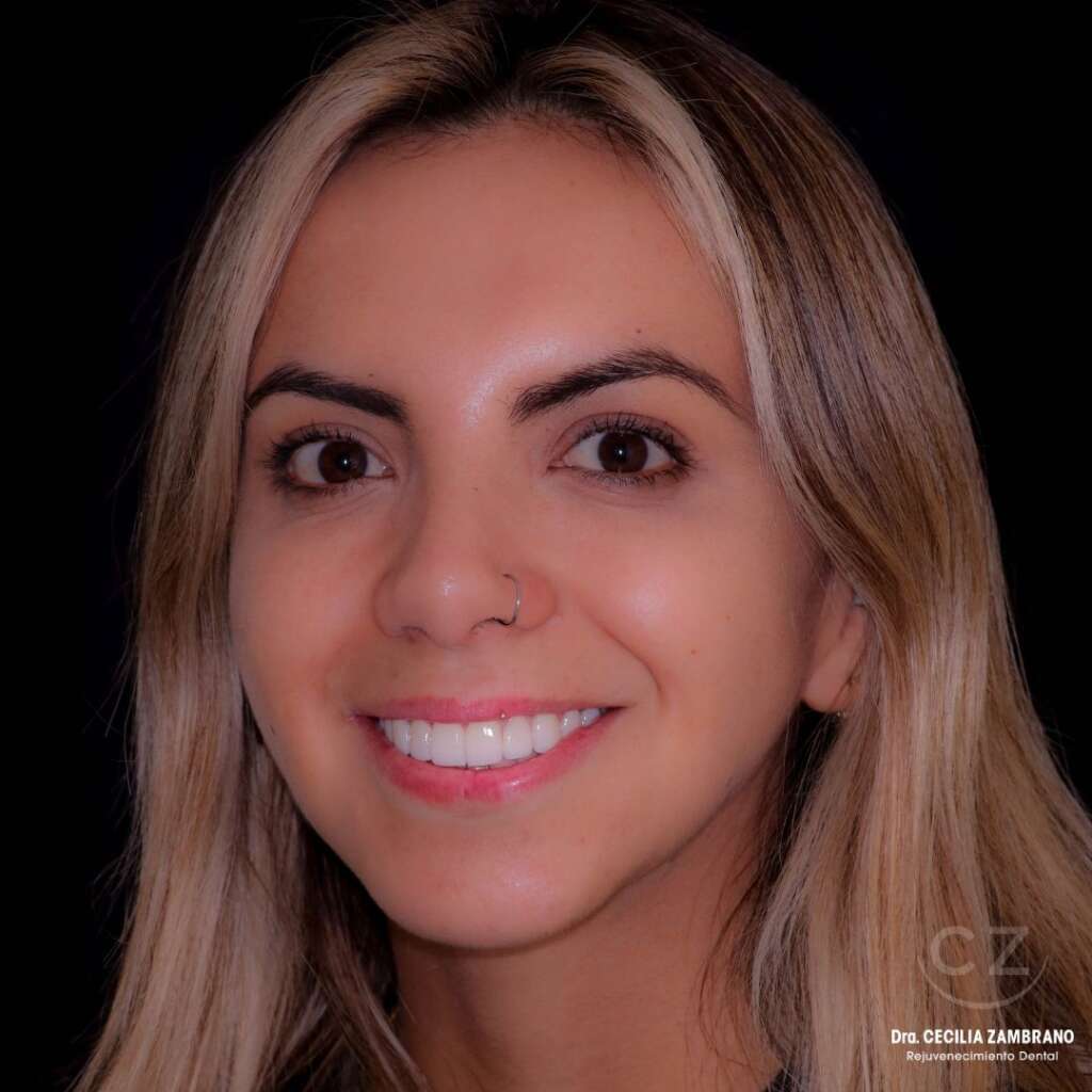 Mujer con sonrisa hermosa | Paciente Diseno de Sonrisa Quito Ecuador