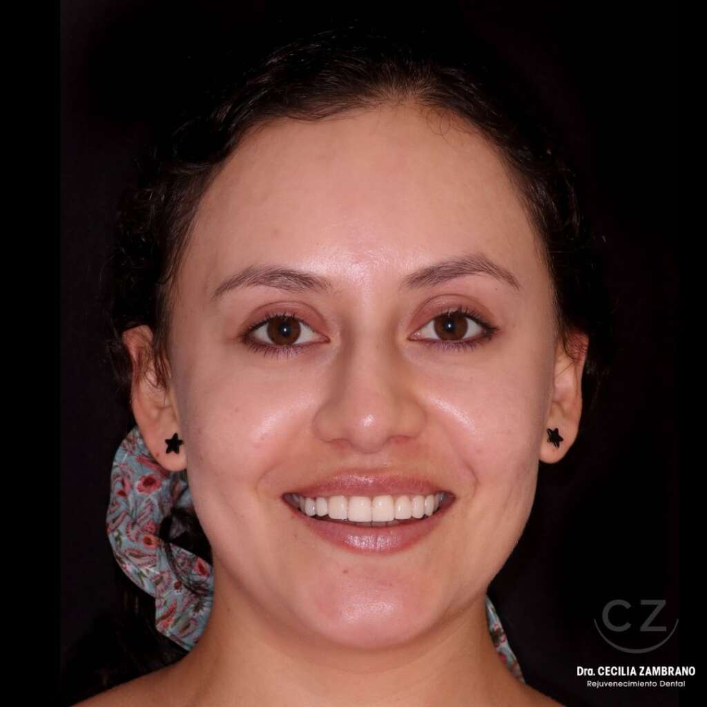 Mujer con sonrisa hermosa | Paciente Diseno de Sonrisa Quito
