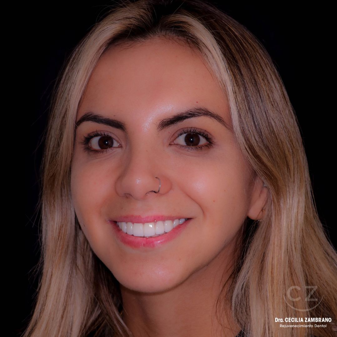 Mujer con sonrisa hermosa | Paciente Diseno de Sonrisa Quito Ecuador