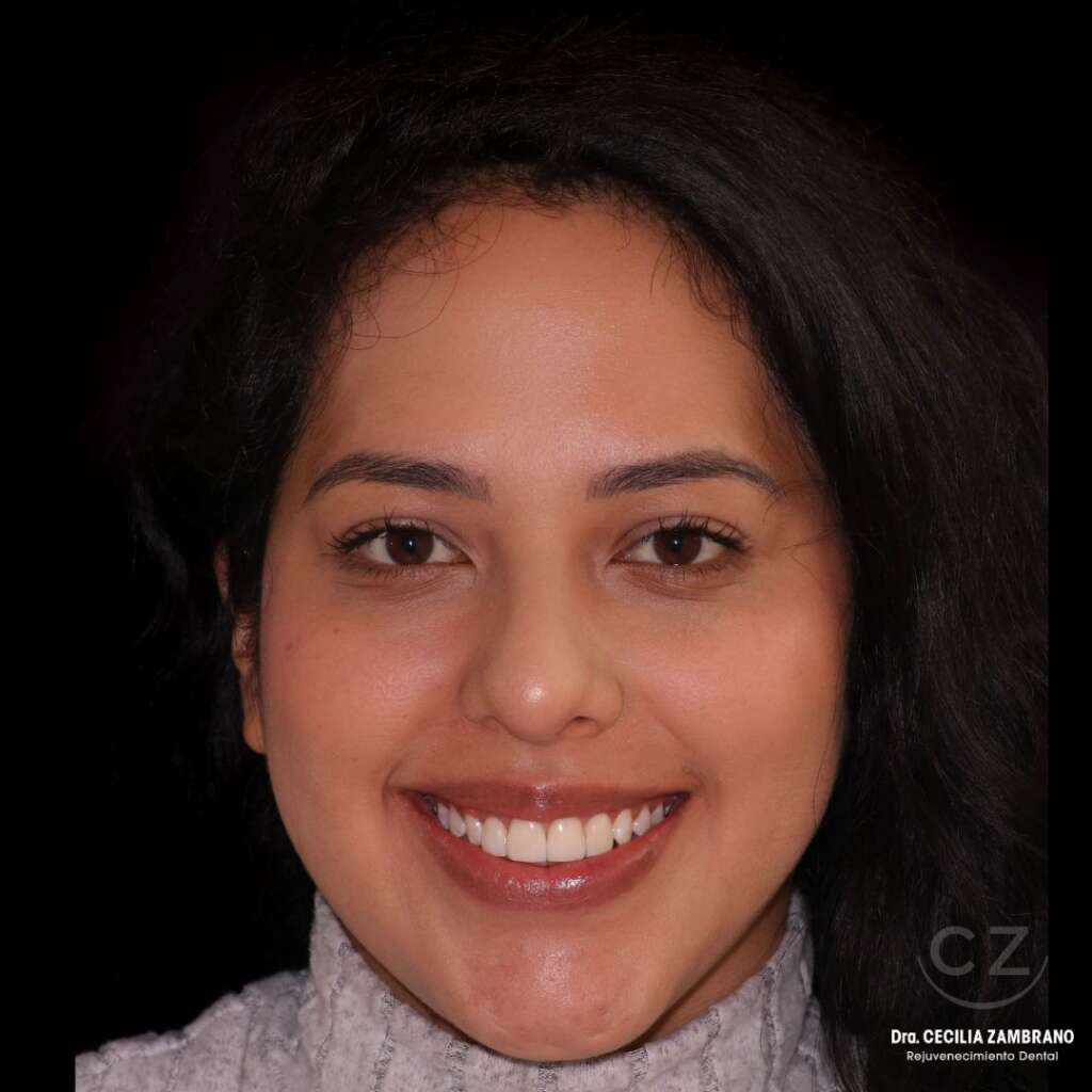 Diseno de Sonrisa Quito Despues del tratamiento