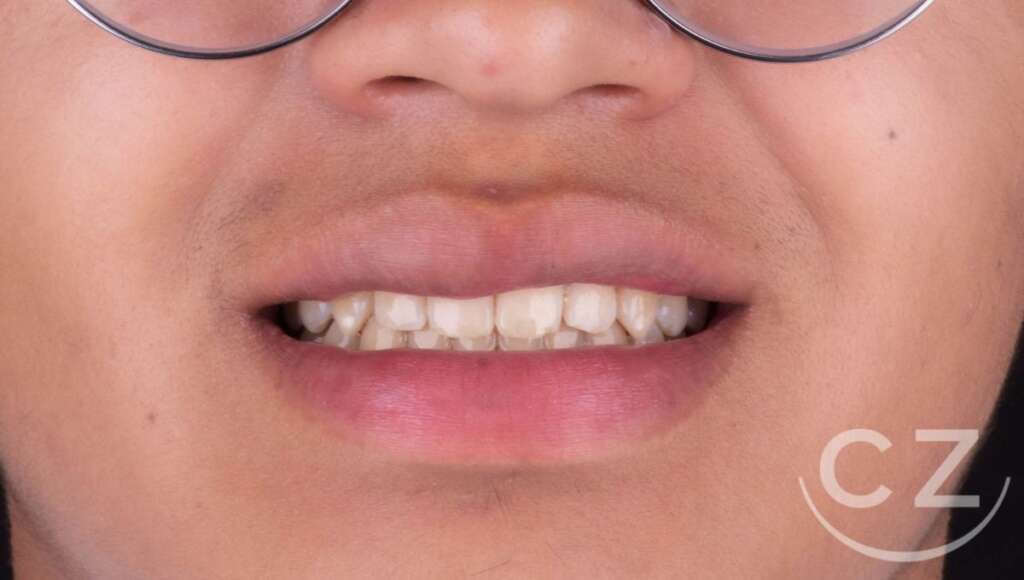 Aclaramiento de dientes amarillos