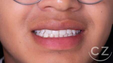 Balanquemiento dental en Quito Dra Cecilia Zambrano