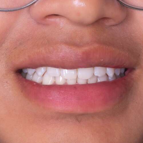 Balanquemiento dental en Quito Dra Cecilia Zambrano