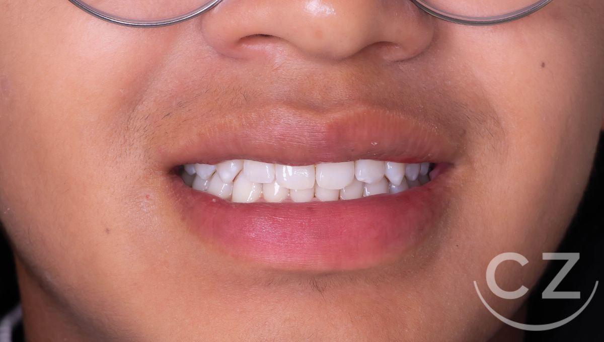 Aclaramiento dental Quito Ecuador Dra. Cecilia Zambrano Despues
