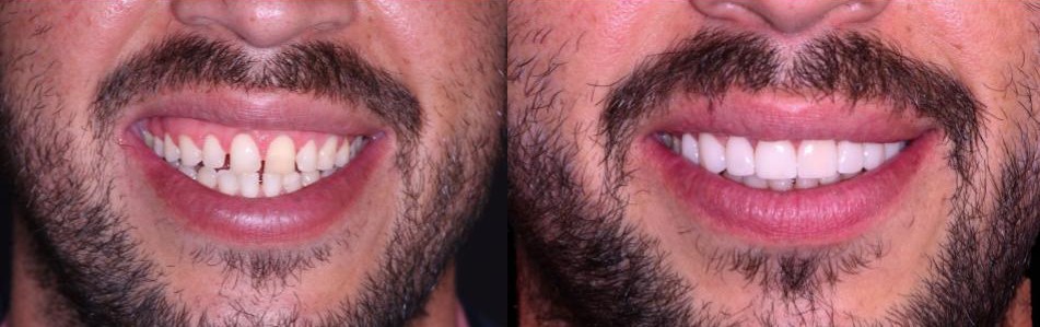 Carillas Dentales Quito Antes y Despues