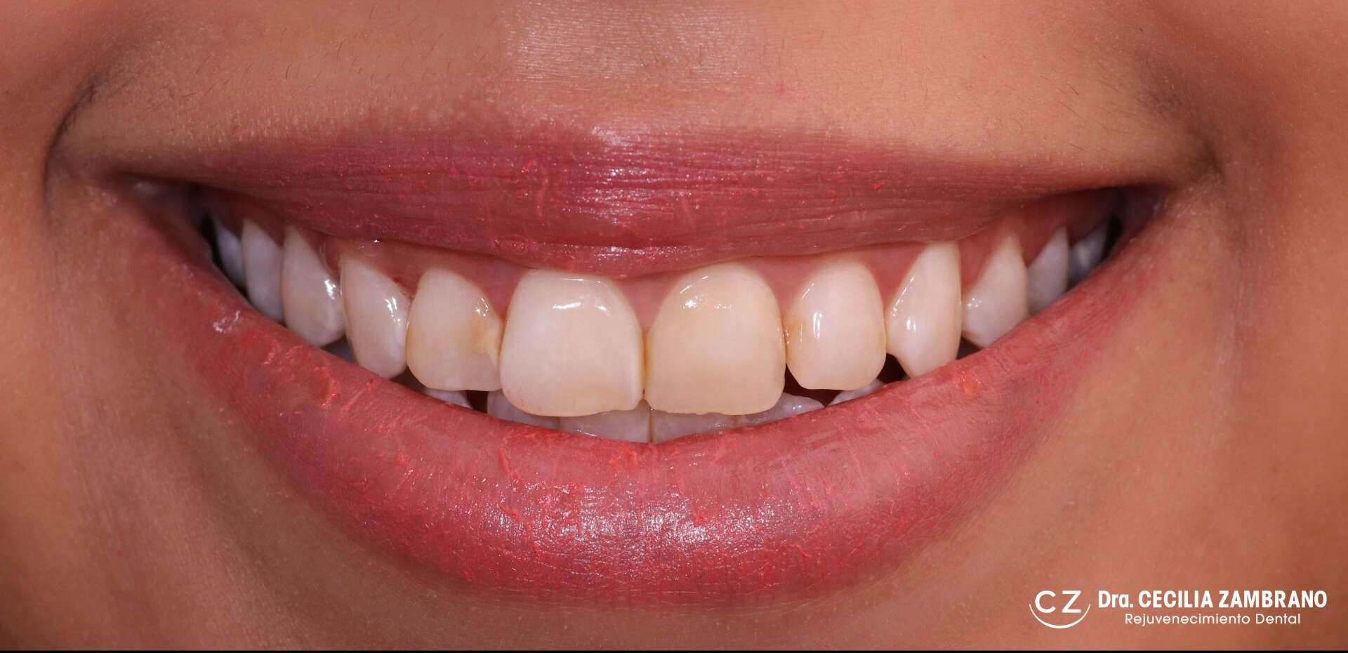 Carillas Dentales Quito Dra. Cecilia Zambrano