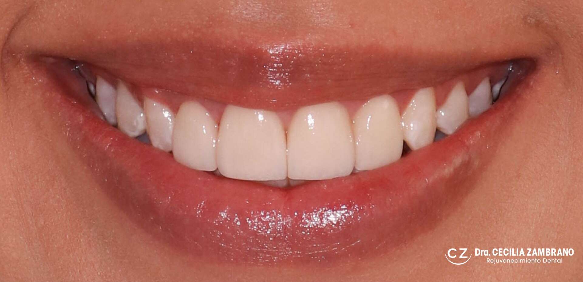 Diseno de Sonrisa - Carillas Dentales en Quito Ecuador