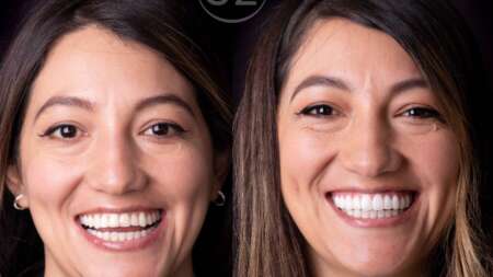 Precio del diseño de sonrisa en Quito