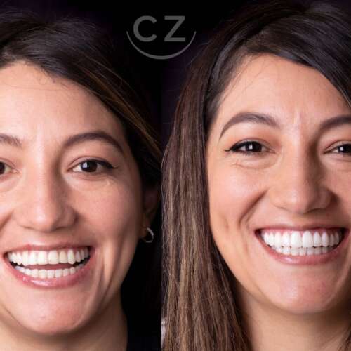 Precio del diseño de sonrisa en Quito