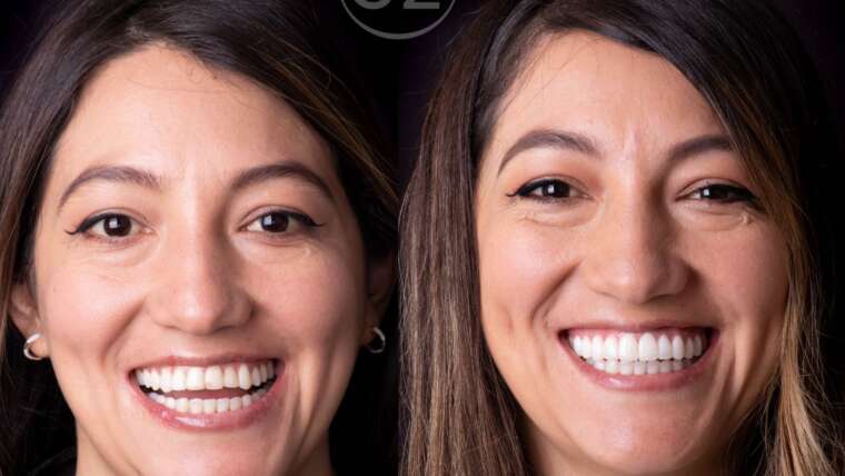 Precio del diseño de sonrisa en Quito